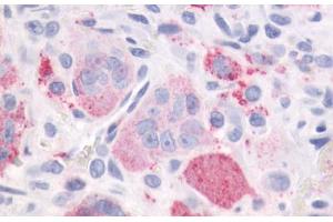 Anti-PTHR / PTHR1 antibody IHC staining of human bone, giant cell tumor. (PTH1R antibody  (Internal Region))