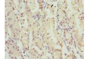 Immunohistochemistry of paraffin-embedded human gastric cancer using ABIN7176368 at dilution of 1:100 (ZNF549 antibody  (AA 1-280))