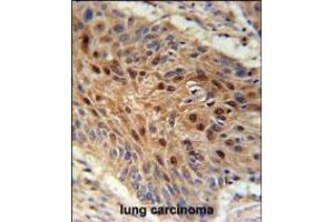 C4orf31 Antibody immunohistochemistry analysis in formalin fixed and paraffin embedded human lung carcinoma followed by peroxidase conjugation of the secondary antibody and DAB staining. (NDNF antibody  (N-Term))