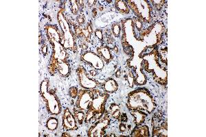 Anti-Tollip antibody, IHC(P) IHC(P): Human Prostatic Cancer Tissue