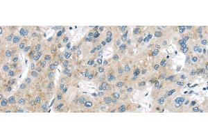 Immunohistochemistry of paraffin-embedded Human liver cancer using VPS26A Polyclonal Antibody at dilution of 1/40 (VPS26A antibody)