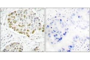 Immunohistochemistry analysis of paraffin-embedded human lung carcinoma tissue, using STAT5A (Ab-725) Antibody. (STAT5A antibody  (AA 696-745))