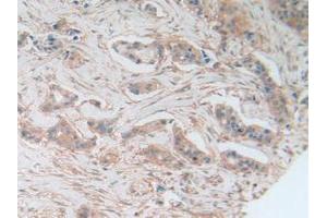 IHC-P analysis of Human Breast Cancer Tissue, with DAB staining. (AKT3 antibody  (AA 46-338))