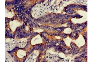 Immunohistochemistry of paraffin-embedded human colon cancer using ABIN7163904 at dilution of 1:100