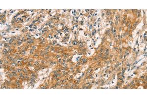 Immunohistochemistry of paraffin-embedded Human gastric cancer tissue using CPA2 Polyclonal Antibody at dilution 1:40