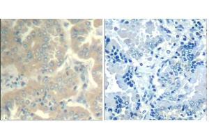 Immunohistochemical analysis of paraffin-embedded human lung carcinoma tissue using FAK (Ab-576/577) Antibody (E021545). (FAK antibody)