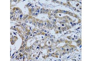 Immunohistochemistry of paraffin-embedded Human colon carcinoma using TPPP3 Polyclonal Antibody at dilution of 1:100 (40x lens). (TPPP3 antibody)