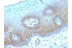 Formalin-fixed, paraffin-embedded human CervicalCarcinoma stained with Thrombomodulin/CD141 Mouse Monoclonal Antibody (THBD/1782). (Thrombomodulin antibody  (AA 69-194))