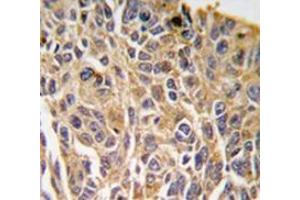 Immunohistochemistry analysis in human lung carcinoma tissue (Formalin-fixed, Paraffin-embedded) using RIPK3 / RIP3  Antibody (N-term), followed by peroxidase-conjugated secondary antibody and DAB staining. (RIPK3 antibody  (N-Term))