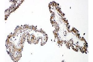 IHC-P: PTH1R antibody testing of human thyroid cancer tissue (PTH1R antibody  (C-Term))