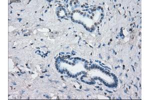 Immunohistochemical staining of paraffin-embedded Adenocarcinoma of colon tissue using anti-KDM4C mouse monoclonal antibody.