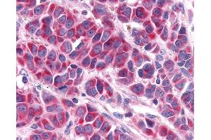 Anti-RORA / ROR Alpha antibody IHC of human Skin, Melanoma. (RORA antibody  (Ligand Binding Domain))