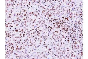 IHC-P Image RecQ1 antibody [N1N2], N-term detects RecQ1 protein at nucleus on human breast carcinoma by immunohistochemical analysis. (RecQ Protein-Like (DNA Helicase Q1-Like) (RECQL) (N-Term) antibody)