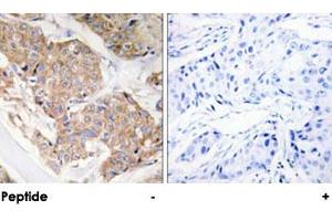 Immunohistochemical analysis of paraffin-embedded human breast carcinoma tissue using IL13RA1 polyclonal antibody .