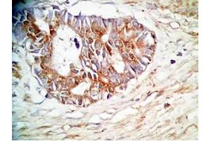 Human stomach cancer tissue was stained by rabbit Anti-Spexin prepro (36-58)  (H) Antiserum (Spexin antibody  (Preproprotein))