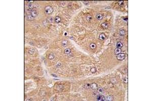 Formalin-fixed and paraffin-embedded human hepatocarcinoma tissue reacted with FUCA2 antibody (N-term) (Cat#AP14356PU-N), which was peroxidase-conjugated to the secondary antibody, followed by DAB staining. (FUCA2 antibody  (N-Term))