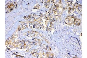 IHC analysis of beta Catenin using anti-beta Catenin antibody . (CTNNB1 antibody  (AA 2-233))