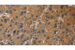 Immunohistochemistry of paraffin-embedded Human liver cancer tissue using DUSP23 Polyclonal Antibody at dilution 1:30 (DUSP23 antibody)