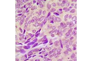 Immunohistochemical analysis of RAB41 staining in human breast cancer formalin fixed paraffin embedded tissue section. (RAB41 antibody  (Center))