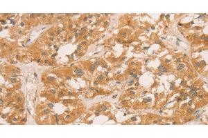 Immunohistochemistry of paraffin-embedded Human thyroid cancer tissue using CPB1 Polyclonal Antibody at dilution of 1:60 (CPB1 antibody)