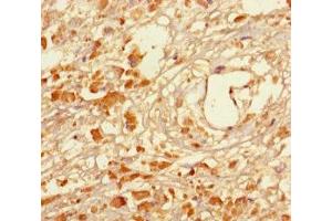 Immunohistochemistry of paraffin-embedded human melanoma using ABIN7159268 at dilution of 1:100