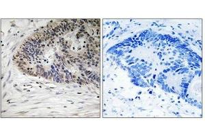 Immunohistochemistry analysis of paraffin-embedded human colon carcinoma tissue using MDM4 (Phospho-Ser367) antibody. (MDM4-binding Protein antibody  (pSer367))