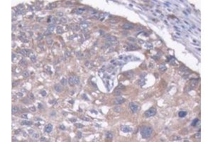DAB staining on IHC-P; Samples: Human Liver cancer Tissue (MAP1B antibody  (AA 2207-2468))