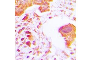Immunohistochemical analysis of Hexokinase 3 staining in human lung cancer formalin fixed paraffin embedded tissue section.