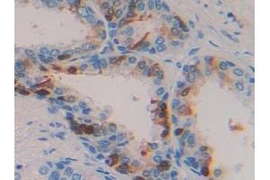 Detection of TGFa in Human Prostate Tissue using Polyclonal Antibody to Transforming Growth Factor Alpha (TGFa) (TGFA antibody  (AA 24-98))