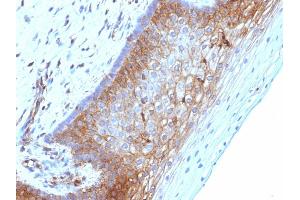 Formalin-fixed, paraffin-embedded human Cervical Ca stained with Beta-2-Microglobulin Mouse Monoclonal Antibody (B2M/1118) (beta-2 Microglobulin antibody)