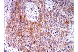 Immunohistochemical analysis of paraffin-embedded cervical cancer tissues using CPV-VP2 mouse mAb with DAB staining. (CPV-VP2 (AA 1-128) antibody)