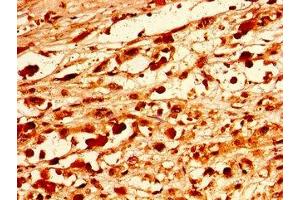 Immunohistochemistry of paraffin-embedded human melanoma using ABIN7162511 at dilution of 1:100 (PAX9 antibody  (AA 163-336))