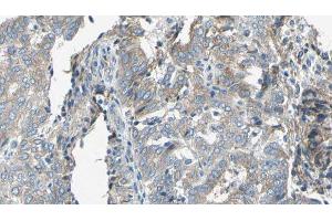 ABIN6276761 at 1/100 staining Human cervical cancer tissue by IHC-P. (TAP2 antibody  (Internal Region))