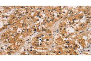 Immunohistochemistry of paraffin-embedded Human thyroid cancer tissue using CTNNBIP1 Polyclonal Antibody at dilution 1:30