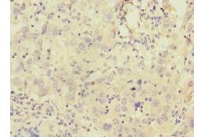 Immunohistochemistry of paraffin-embedded human liver cancer using ABIN7146291 at dilution of 1:100 (Calcitonin Receptor antibody  (AA 25-148))