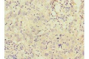 Immunohistochemistry of paraffin-embedded human liver cancer using ABIN7146291 at dilution of 1:100