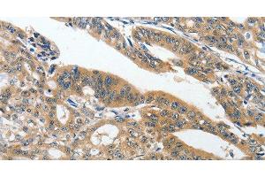 Immunohistochemistry of paraffin-embedded Human gasrtic cancer tissue using ANKZF1 Polyclonal Antibody at dilution 1:40