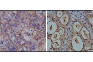 Immunohistochemical analysis of paraffin-embedded human breast carcinoma (left) and kidney carcinoma (right), showing cytoplasmic localization using GAPDH antibody with DAB staining. (GAPDH antibody)