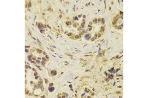 Immunohistochemistry of paraffin-embedded human breast cancer using DOK1 Antibody. (DOK1 antibody)