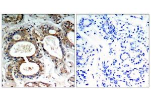 Immunohistochemical analysis of paraffin-embedded human breast carcinoma tissue, using SHP-2 (Phospho-Tyr542) antibody (E011319). (PTPN11 antibody  (pTyr542))