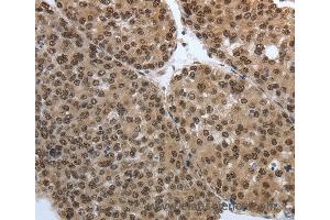 Immunohistochemistry of Human thyroid cancer using SMAD7 Polyclonal Antibody at dilution of 1:40 (SMAD7 antibody)