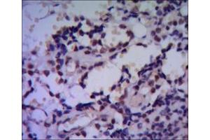 Immunohistochemical analysis of paraffin-embedded human breast cancer using HSP70 mouse mAb with DAB staining.