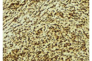 ABIN6274149 at 1/100 staining Human breast cancer tissue by IHC-P. (HMGN2 antibody  (Internal Region))