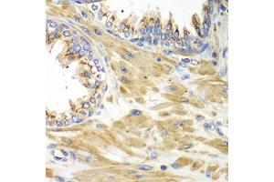 Immunohistochemistry of paraffin-embedded human prostate using PICK1 antibody (ABIN6291515) at dilution of 1:100 (40x lens).