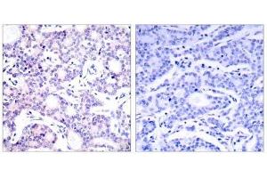 Immunohistochemical analysis of paraffin-embedded human breast carcinoma tissue using NF-κB p105/p50 (Ab-893) antibody (E021018). (NFKB1 antibody)