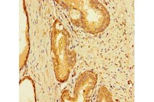 Immunohistochemistry of paraffin-embedded human prostate cancer using ABIN7156421 at dilution of 1:100