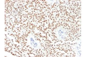 Formalin-fixed, paraffin-embedded human Bladder Carcinoma stained with FOXA1 Monoclonal Antibody (FOXA1/1241). (FOXA1 antibody  (AA 372-472))