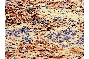 Immunohistochemistry analysis of human bladder cancer using ABIN7171814 at dilution of 1:100 (TEX43 antibody  (AA 1-134))