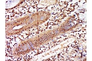 Paraformaldehyde-fixed, paraffin embedded human cervical carcinoma tissue, Antigen retrieval by boiling in sodium citrate buffer(pH6) for 15min, Block endogenous peroxidase by 3% hydrogen peroxide for 30 minutes, Blocking buffer (normal goat serum) at 37°C for 20min, Antibody incubation with Rabbit Anti-ZNF740 Polyclonal Antibody, Unconjugated  at 1:500 overnight at 4°C, followed by a conjugated secondary and DAB staining (ZNF740 antibody  (AA 101-193))