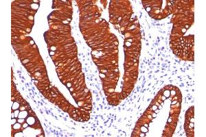 Formalin-fixed, paraffin-embedded colon carcinoma stained with Cytokeratin 19 Mouse Monoclonal Antibody (A53-B/A2. (Cytokeratin 19 antibody)